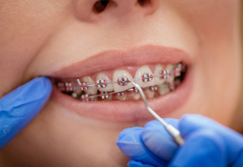 Niềng răng là phương pháp nha khoa được áp dụng nhằm điều chỉnh sự sai lệch vị trí của răng và khớp cắn, từ đó nâng cao chức năng ăn nhai và tính thẩm mỹ của răng.