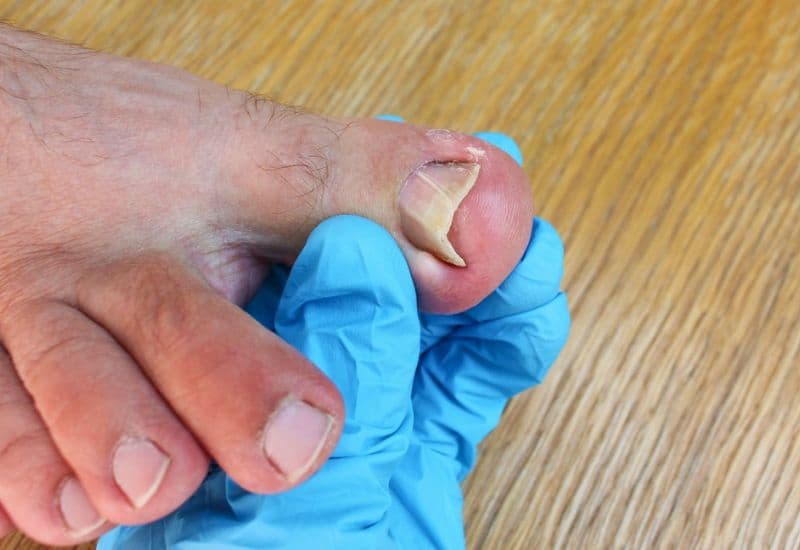 xử trí móng quặp an toàn và hiệu quả