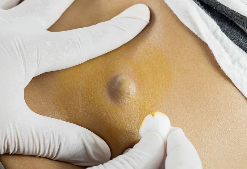 Các phương pháp điều trị u bã đậu 