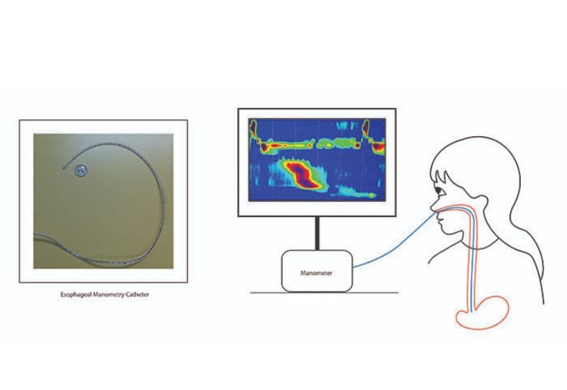 Đo áp lực thực quản HRM là gì?