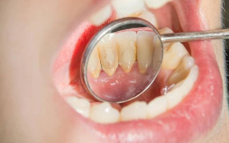 Dụng cụ lấy cao răng tại nhà là gì