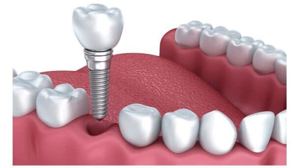 Trồng răng Implant là một phương pháp rất tiến bộ trong Nha khoa.