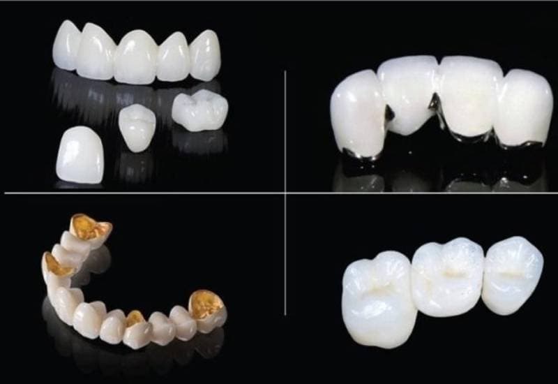 giá tiền 1 hàm răng sứ bao nhiêu tiền