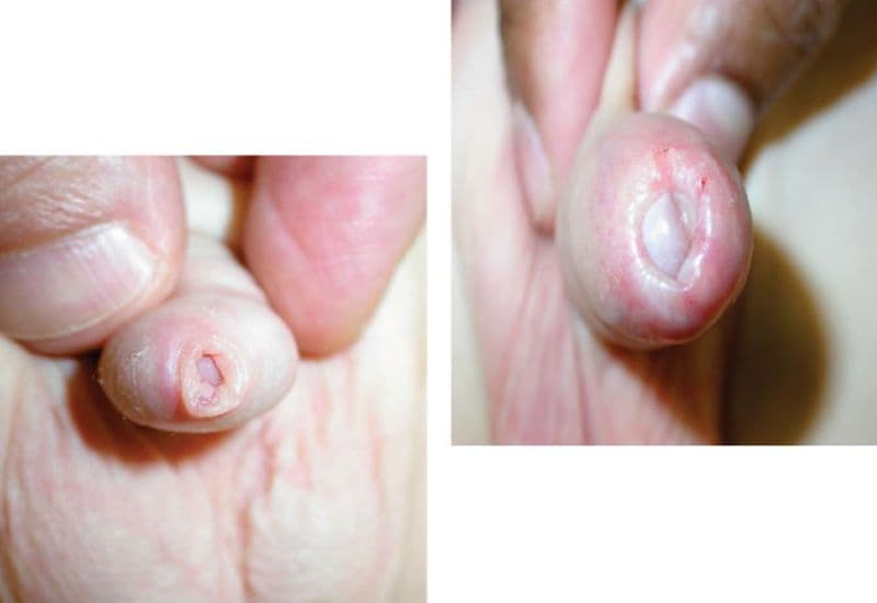 hẹp bao quy đầu biến chứng viêm nhiễm