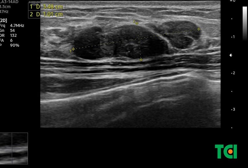 Phát hiện 7 khối ở 2 bên vú khiến chị T vô cùng lo lắng