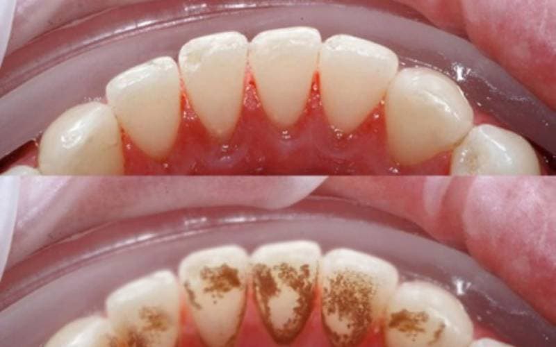 kem đánh răng tẩy cao răng ở đâu