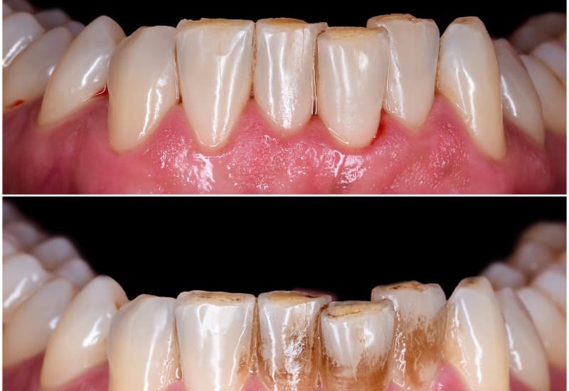 Cao răng là một lớp cứng hình thành trên bề mặt răng do quá trình khoáng hóa của mảng bám. 