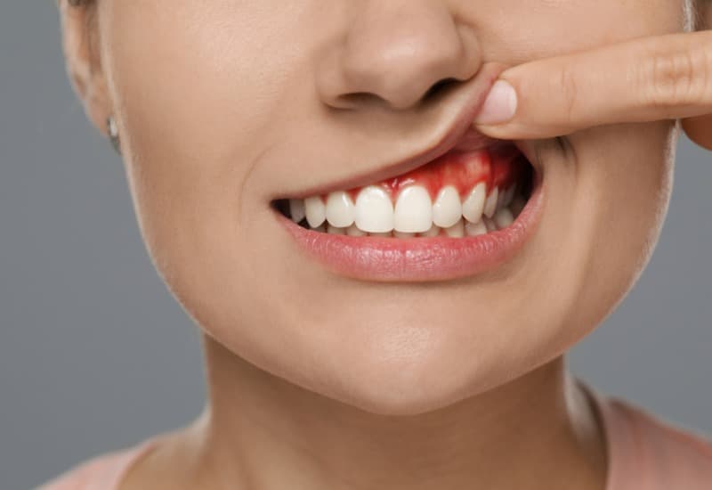 Sự tồn tại của cao răng không chỉ ảnh hưởng đến thẩm mỹ mà còn gây ra nhiều tác hại lâu dài cho sức khỏe răng miệng. 