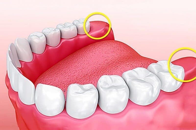 ảnh lợi trong cùng bị sưng