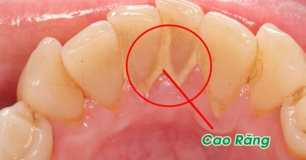 Mảng bám cứng trên răng được hình thành từ chính các mảng bám mềm.