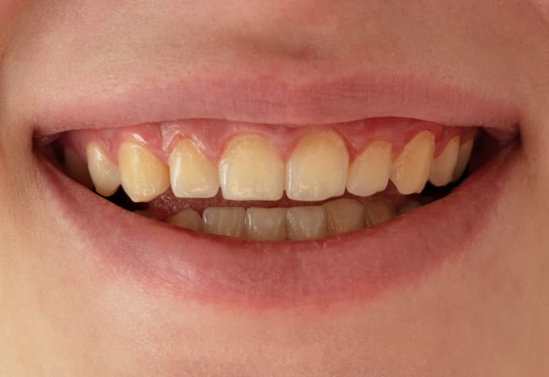 Giải đáp chi tiết thắc mắc: Mặt dán sứ veneer là gì?