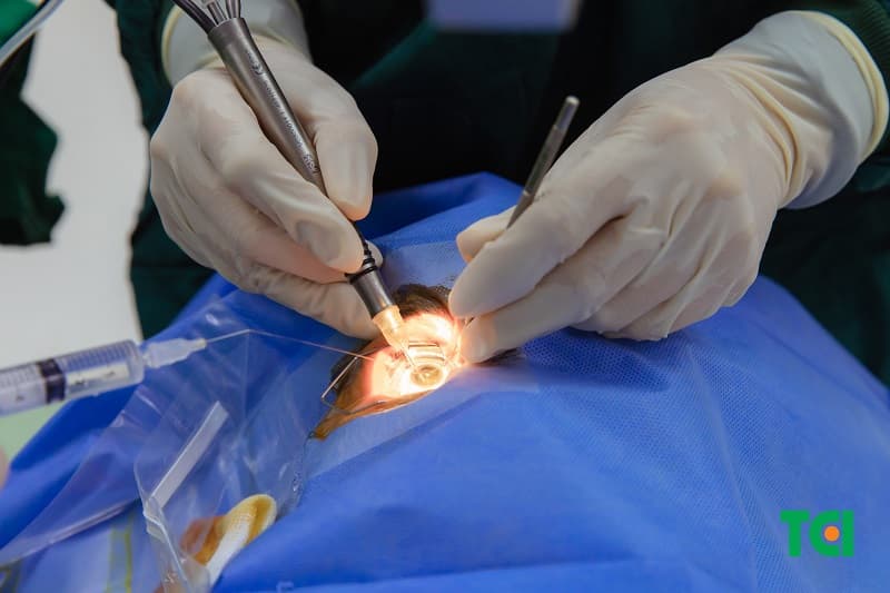 Ứng dụng máy phẫu thuật Phaco lấy lại đôi mắt sáng cho người bệnh