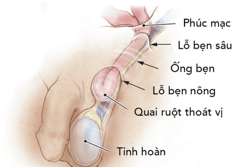 mổ thoát vị bẹn