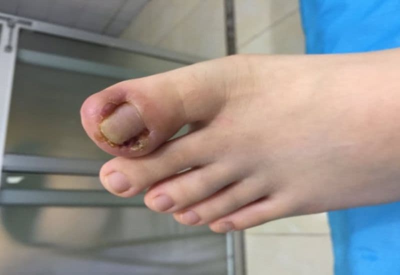 dấu hiệu móng quặp 