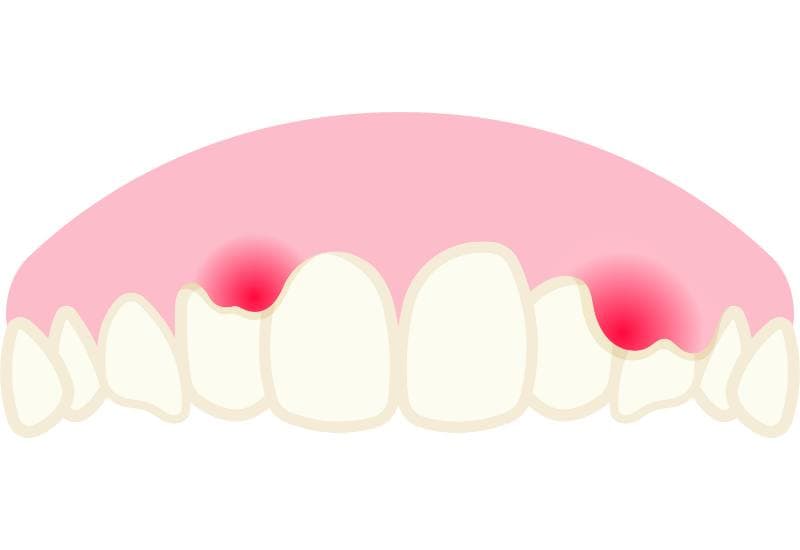 Vôi răng tích tụ quanh chân răng có thể dẫn đến viêm nướu, khiến nướu đỏ, sưng và dễ chảy máu khi đánh răng hoặc dùng chỉ nha khoa.