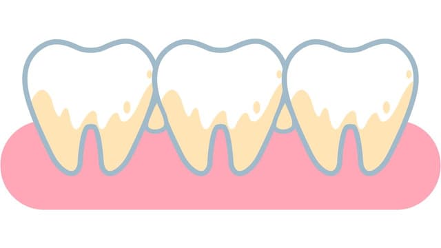 Nguyên nhân bị vôi răng và cách dự phòng