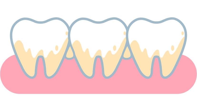 Nguyên nhân bị vôi răng và cách dự phòng