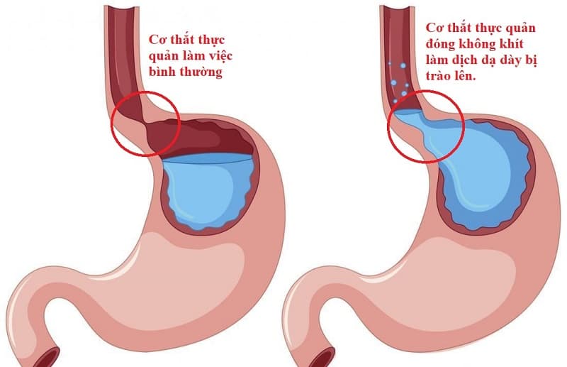 Nguyên nhân gây nuốt vướng trào ngược