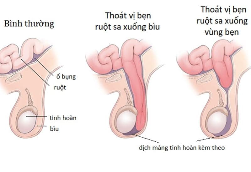 các loại thoát vị bẹn 