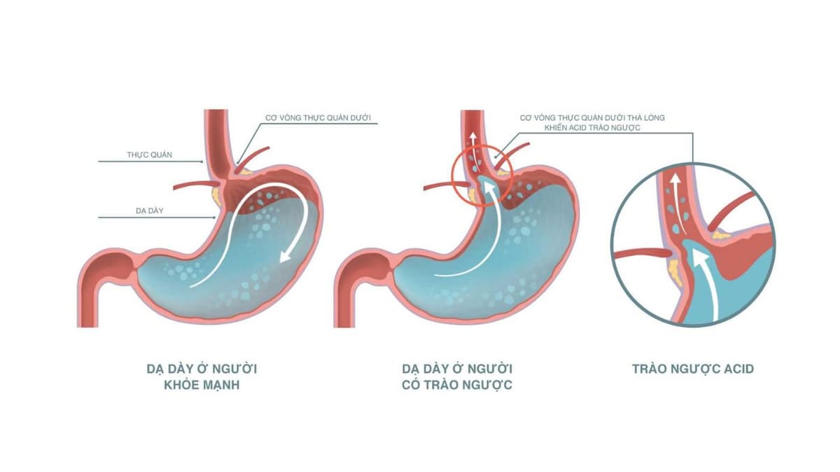 Các nguyên nhân trào ngược phổ biến và cách chẩn đoán