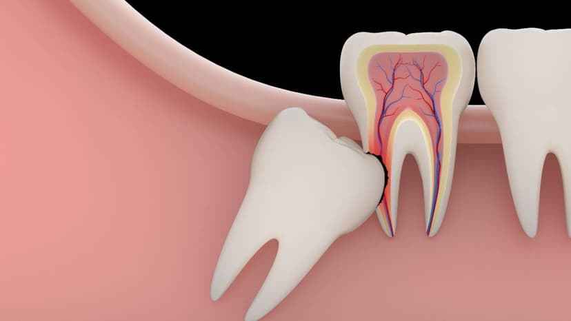 Nhổ răng khôn hàm dưới bao nhiêu tiền – Cách xác định chi phí