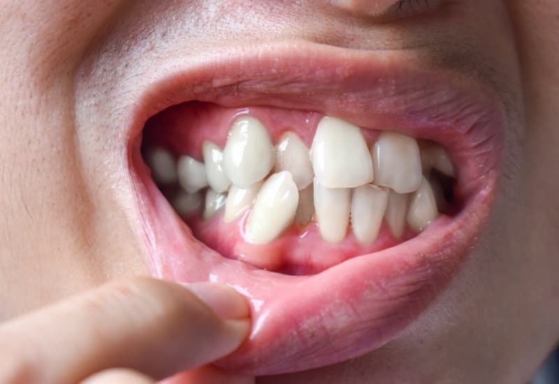 Giải đáp chi tiết thắc mắc: Niềng răng giá bao nhiêu?