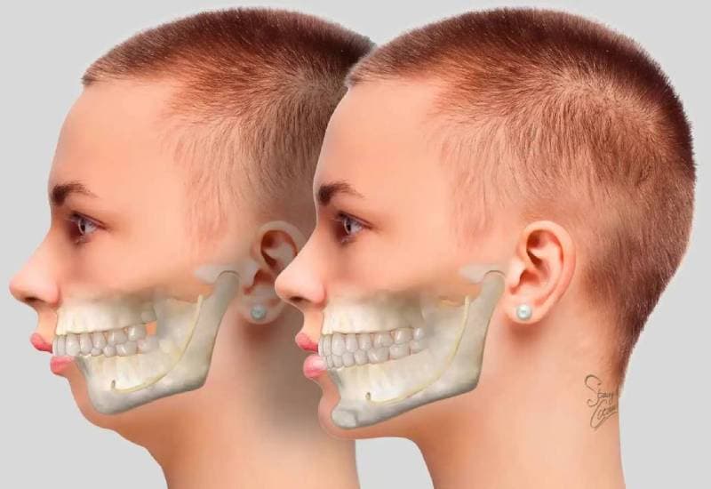 Niềng răng hô mất bao lâu nhỉ