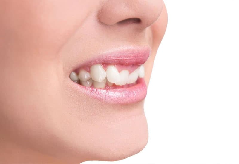 Niềng răng khểnh là gì