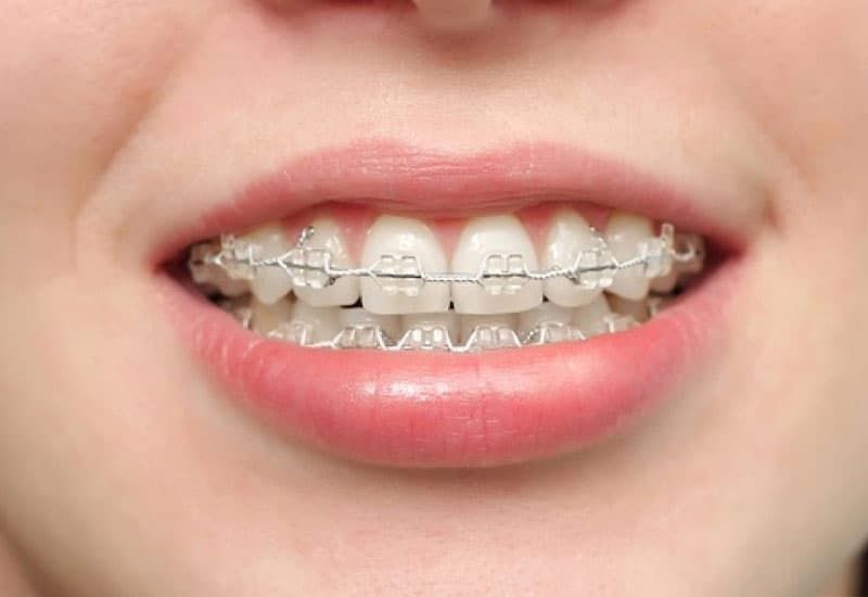 Niềng răng khểnh có tốt không