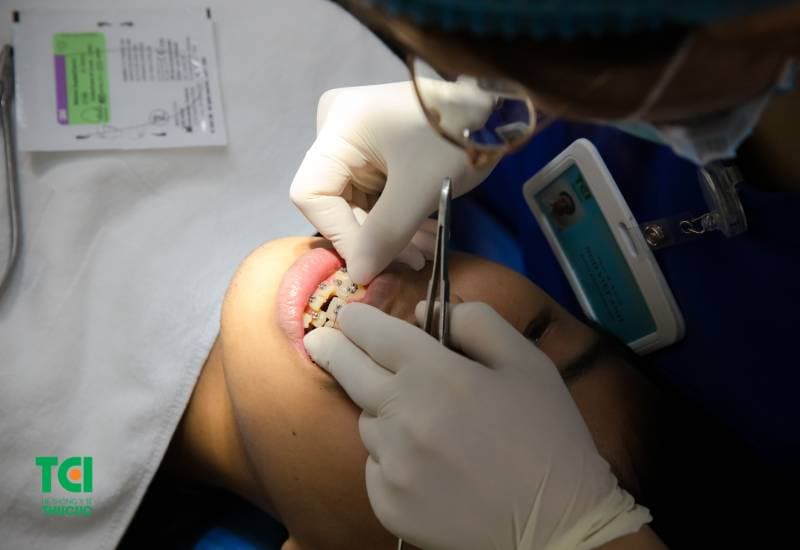 Niềng răng mất bao lâu ạ