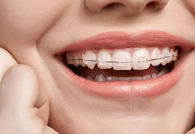 Niềng răng pha lê bằng cách nào