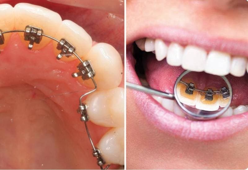 Niềng răng sứ thẩm mỹ bằng cách nào