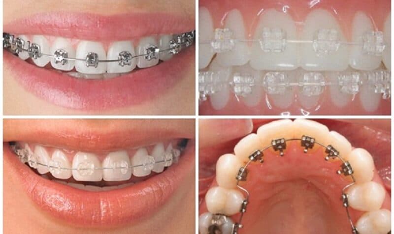 niềng răng tại Hà Nội ở đâu