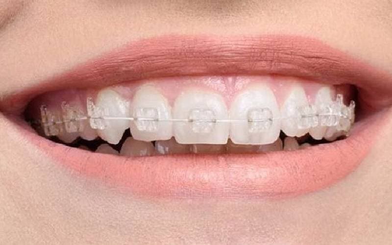 có nên niềng răng tại Hà Nội