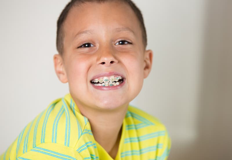 Giải đáp chi tiết thắc mắc: Niềng răng trong bao lâu?