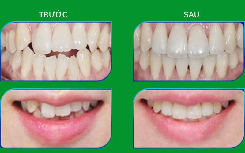 niềng răng trước và sau như thế nào