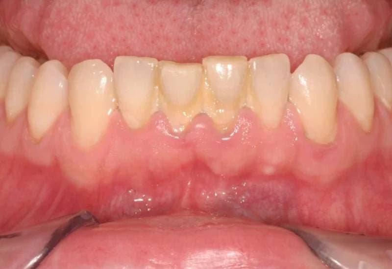 hỏi về Nước súc miệng lấy cao răng