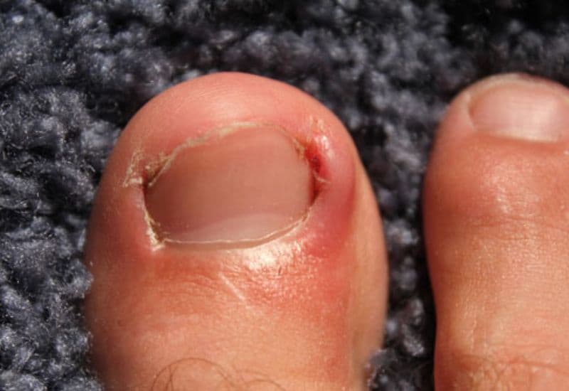 phân biệt bệnh móng quặp thịt và chín mé