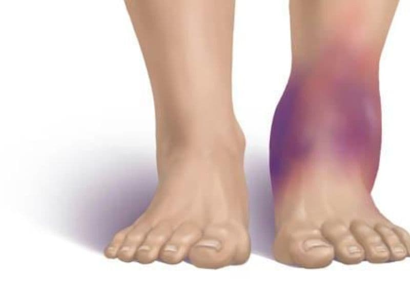 phân biệt trật khớp và bong gân