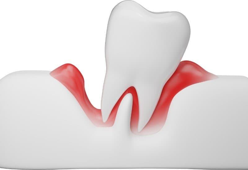 Phẫu thuật ghép lợi là một thủ thuật nha khoa, được thực hiện nhằm cải thiện tình trạng của lợi khi chúng bị tổn thương. 