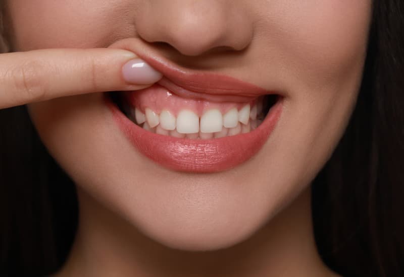 Giải đáp chi tiết thắc mắc: Phẫu thuật ghép lợi hết bao nhiêu tiền?