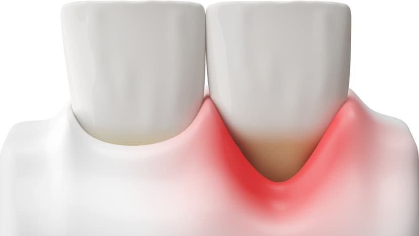 Giá phẫu thuật ghép lợi và những yếu tố ảnh hưởng