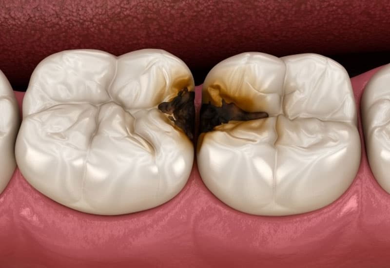 Phí lấy cao răng rẻ không