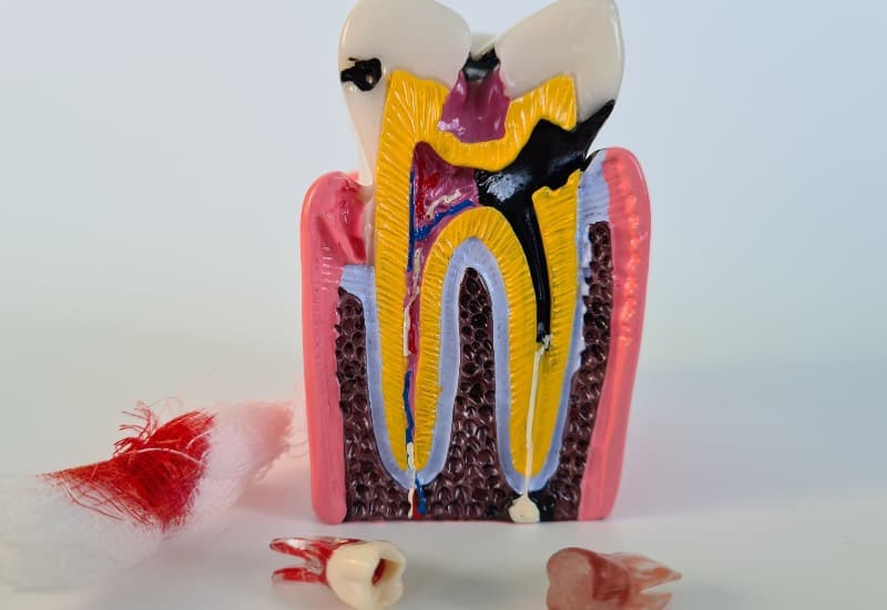 Viêm tủy răng là một trong những trường hợp được chỉ định điều trị tủy răng.