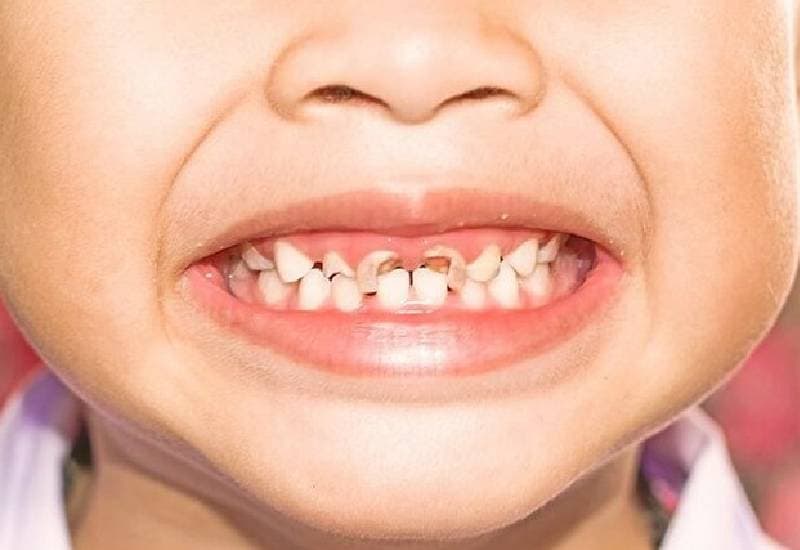 răng cửa bị sâu là gì