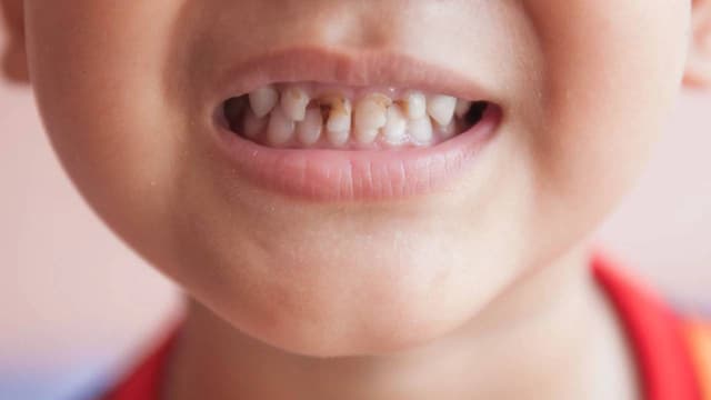 Răng cửa bị sâu: “Khắc tinh” của nụ cười rạng rỡ