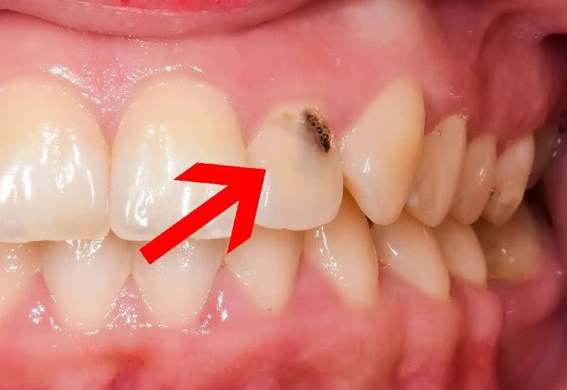 nhận biết răng cửa bị sâu