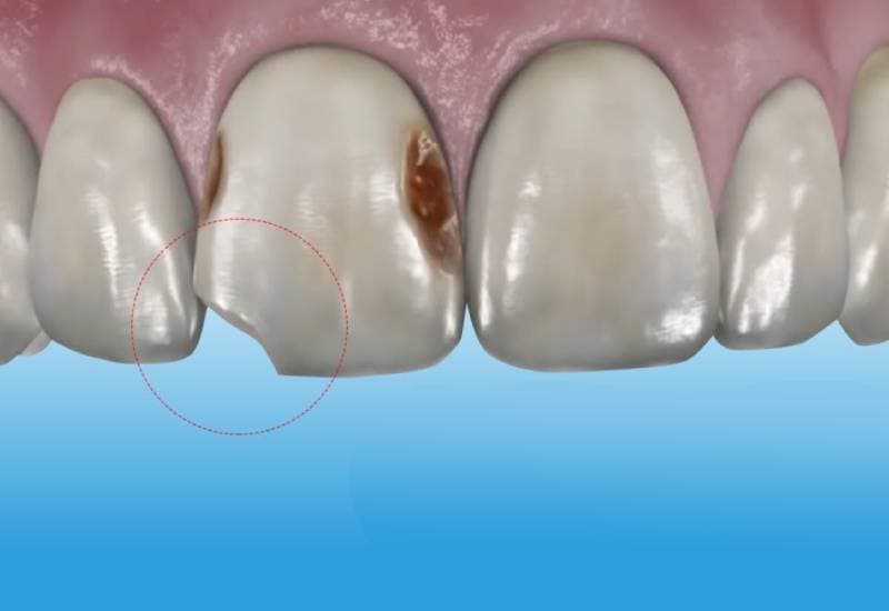hình ảnh răng cửa bị sâu và mẻ