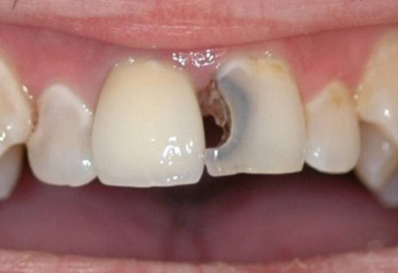 Răng cửa bị sâu và mẻ nguy hiểm không