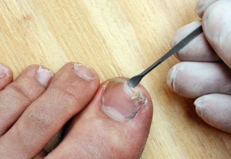 bị móng quặp tuyệt đối không nên tự ý nặn khoét mủ. 